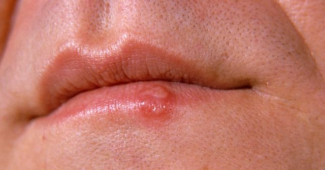 입술 헤르페스 원인