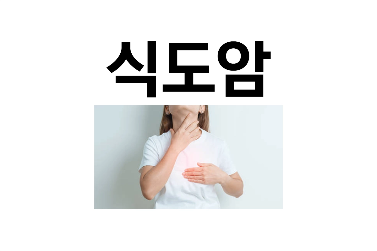 식도암 원인 증상 진단 치료 예방