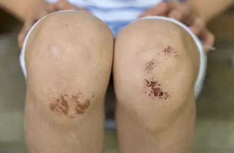 비브리오 패혈증 증상 18가지