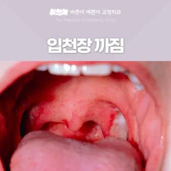 입천장 헐었을 때 면역력 저하 관련 증상과 영양 관리법_21