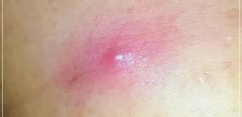 엉덩이 종기가 생기는 이유 왜 생기고 어떻게 관리할까요 완벽 가이드_9