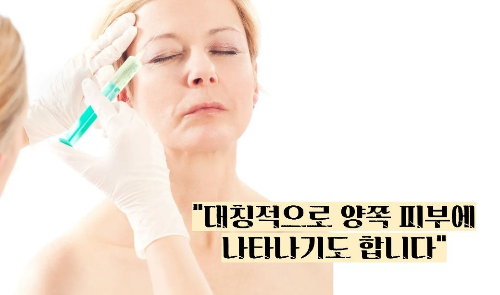 백반증 초기증상