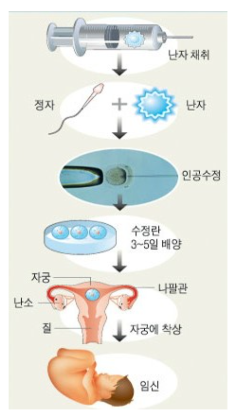 시험관 아기 시술과정