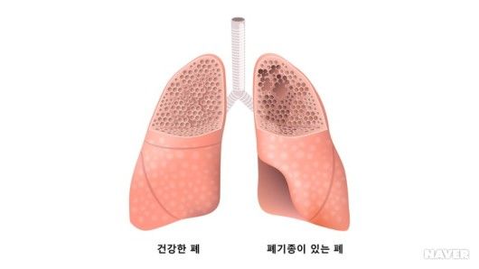 만성 폐쇄성 폐질환