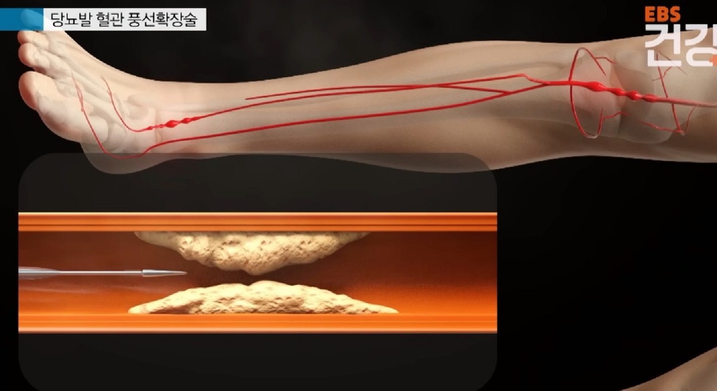 당뇨발-혈관-풍선확장술