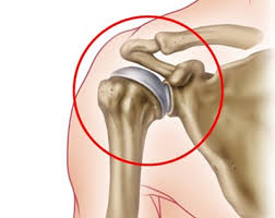 관절경수술 후 물리치료 운동 가이드
