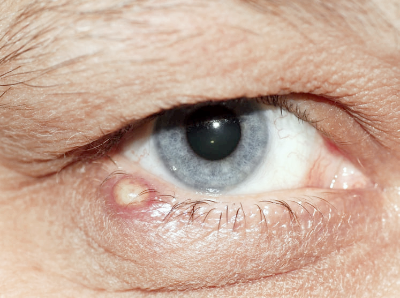 눈 다래끼 원인과 빨리 낫는 법