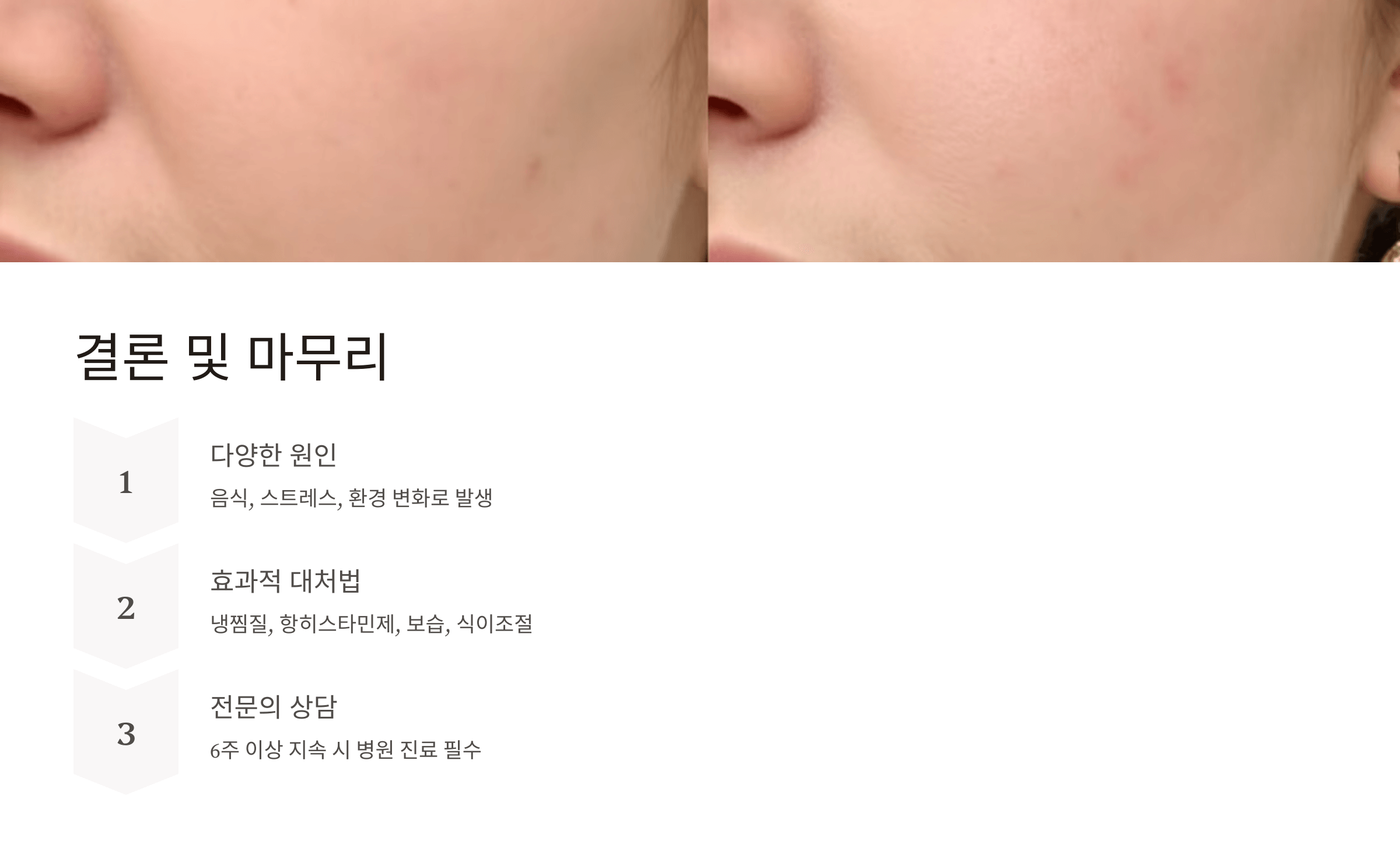 두드러기와 관련된 사진입니다.