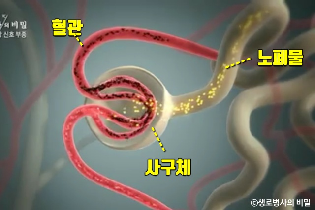 종아리 얼굴 붓는 이유, 붓기 부기 부종 원인 증상, 생로병사의 비밀, 다이어트 건강, 팁줌 매일꿀정보