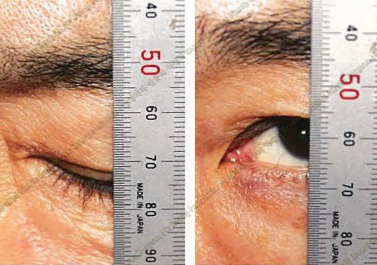 Berke&rsquo;s method