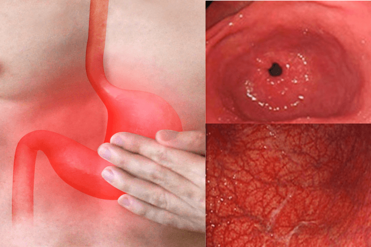 위염, 급성위염, 만성위염