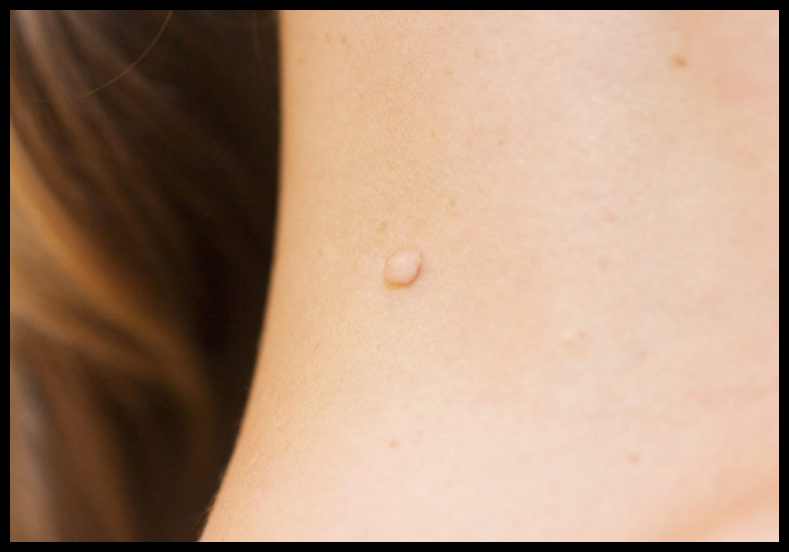 쥐젖 제거 크림