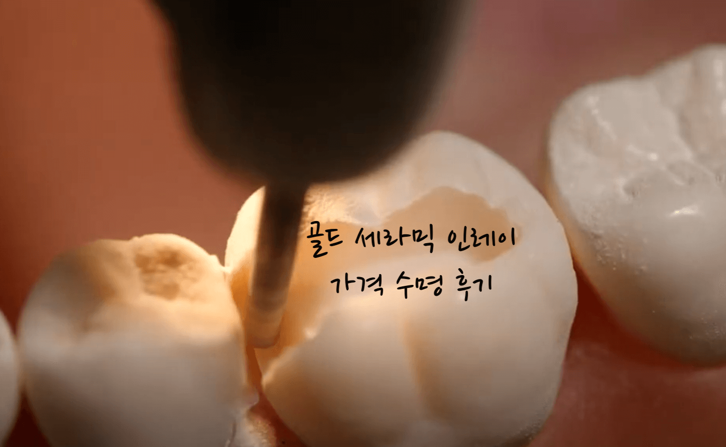 골드 세라믹