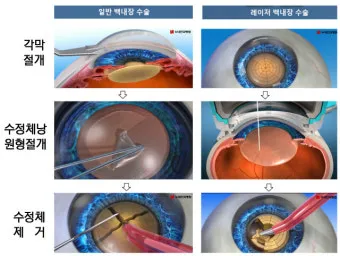 백내장 수술 비용 실비 보험 청구 회복기간_7