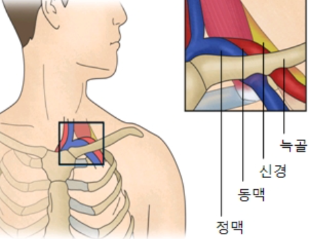 흉곽출구증후근 그림