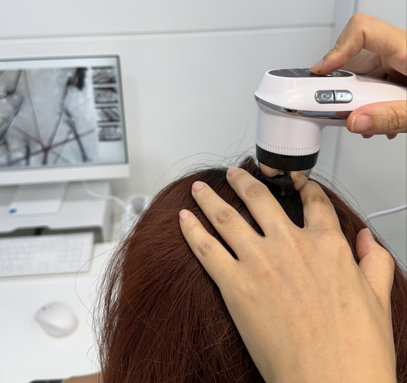 술과 탈모의 관계