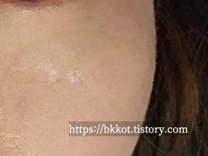 리팟레이저 후기