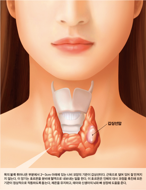 ebs 명의 갑상선 치료 예방