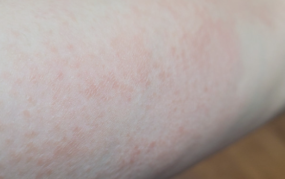 글루타민의 효능 효과와 L -글루타민 그리고 글루타민의 부작용