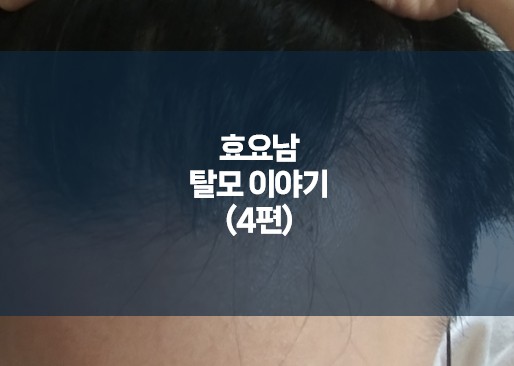 탈모 모발이식 수술 후기-2주차 암흑기