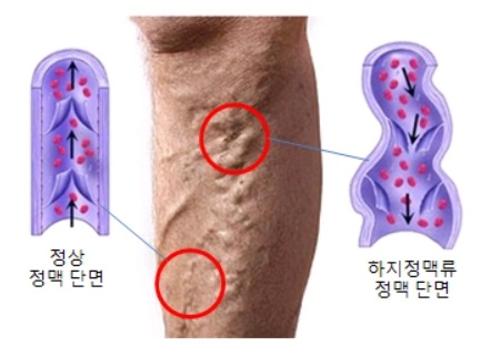 하지정맥류_초기증상_치료방법