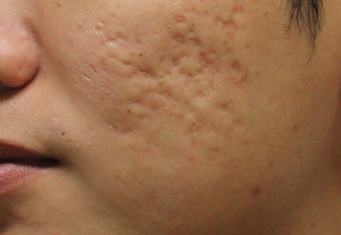 여드름 난 남성의 볼