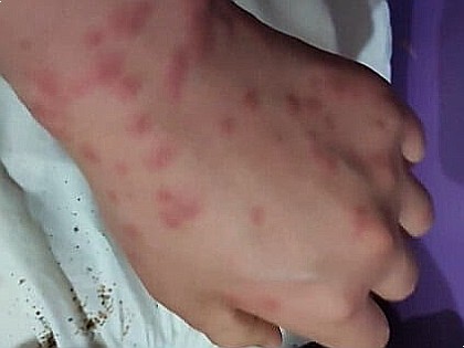 빈대 물린자국 퇴치 방법(feat. 물리면 바르는 약)