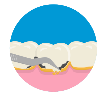 스케일링 가격? 의료보험 적용 비용 가이드