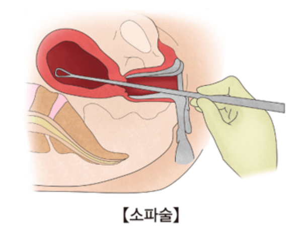 소파술