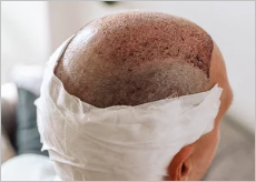 모발이식 시술한 남성의 두피 이미지