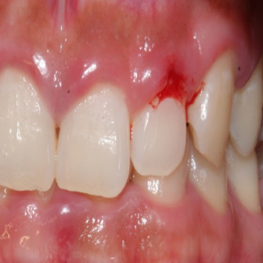 잇몸이 붓고 피가 날때 원인과 관리 예방-동의보감 血