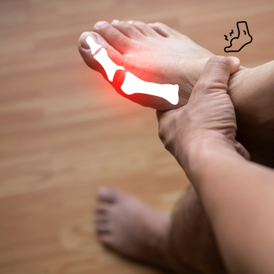 통풍의 원인과 시기별 증상, 예방