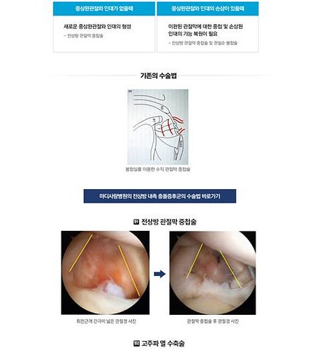 어깨충돌증후군수술