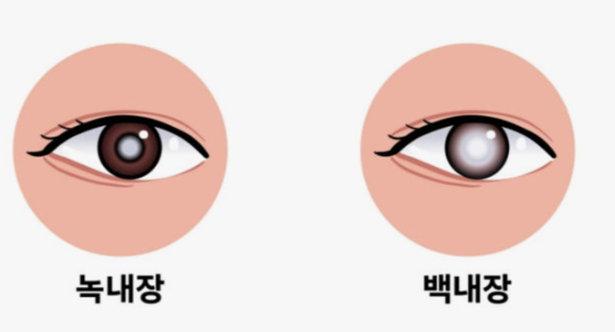 백내장 원인과 치료방법