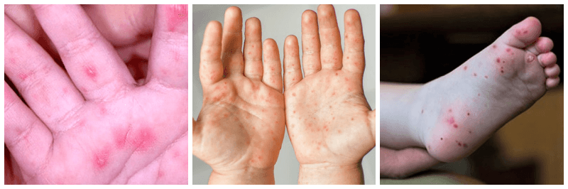 수족구병 관련 사진 3개