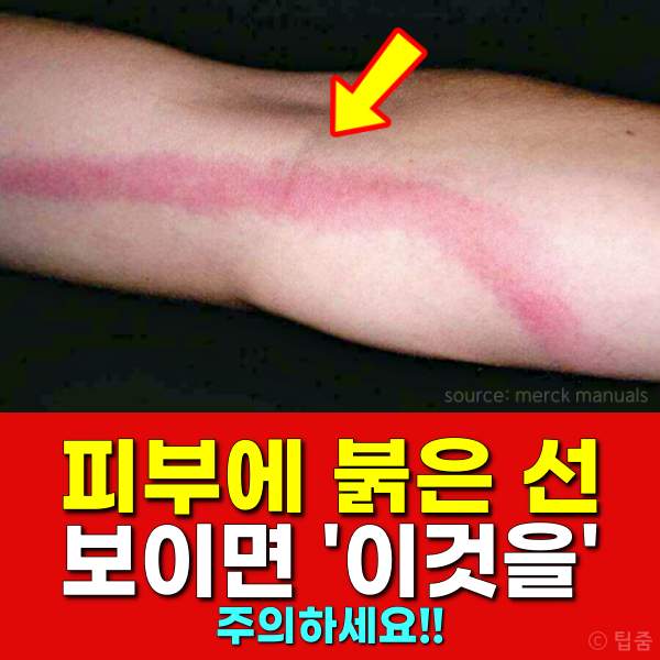 피부에 붉은 선,피부에 붉은자국,패혈증 증상,팁줌