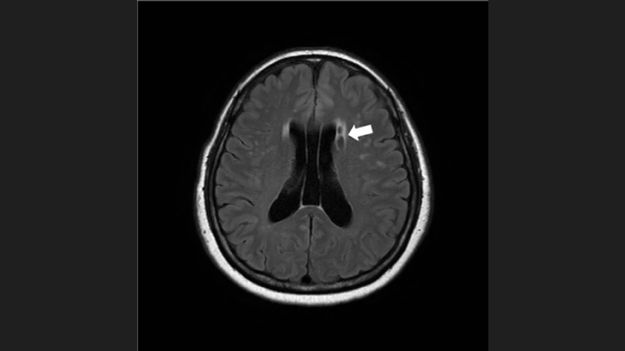 뇌졸중 전조증상