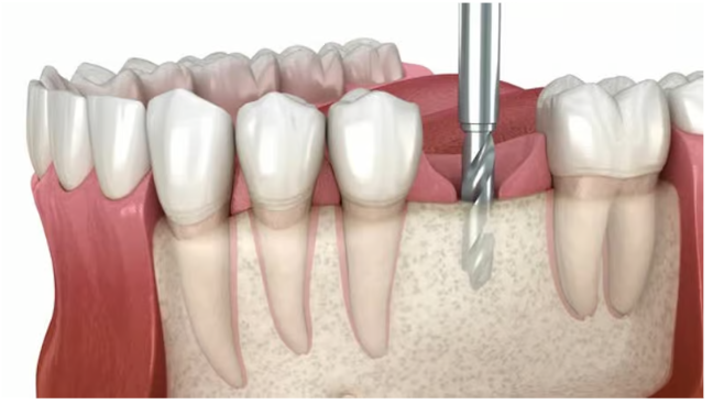임플란트 뼈이식