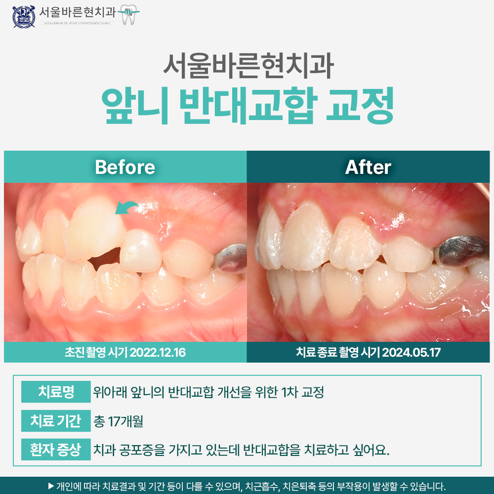 해운대앞니교정치과추천