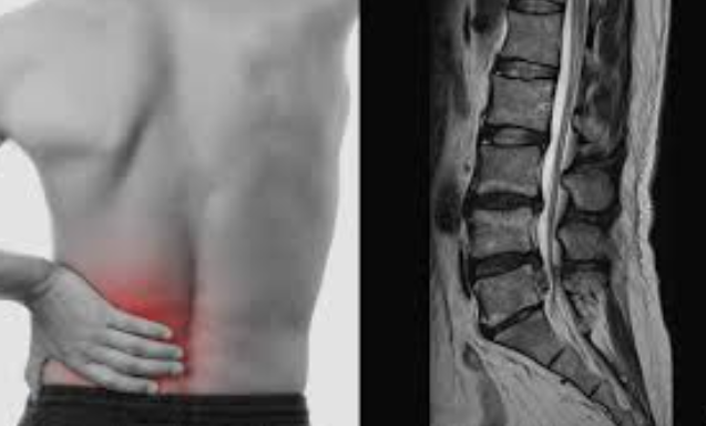 허리디스크 증상