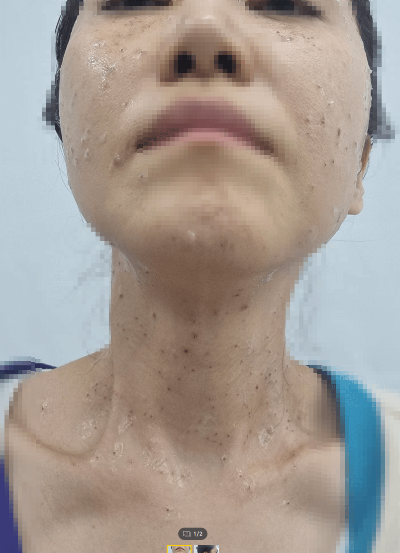 편사제거
