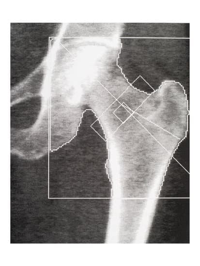 골밀도 검사(Bone Mineral Density, BMD)란?