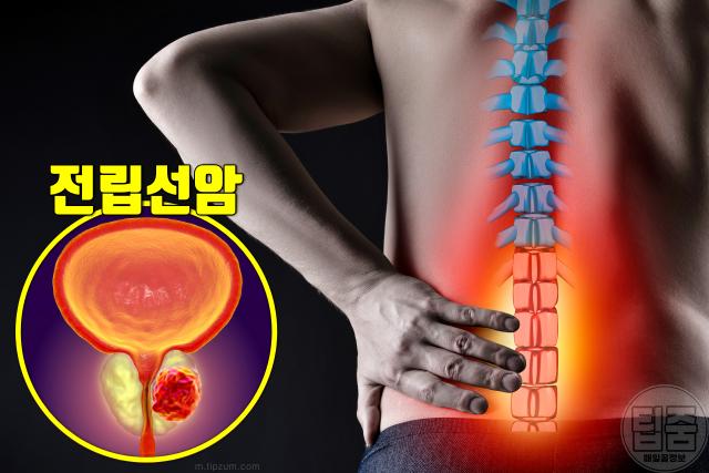 전립선 안좋을때 증상 허리통증 골반통증 전립선암