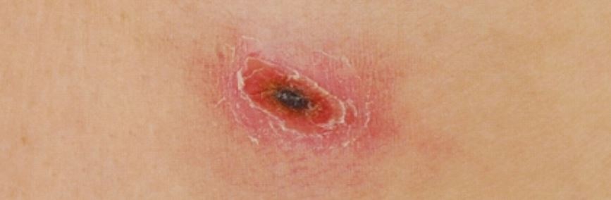 쯔쯔가무시 증상 물린자국