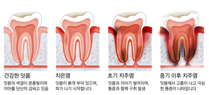치은염과치주염
