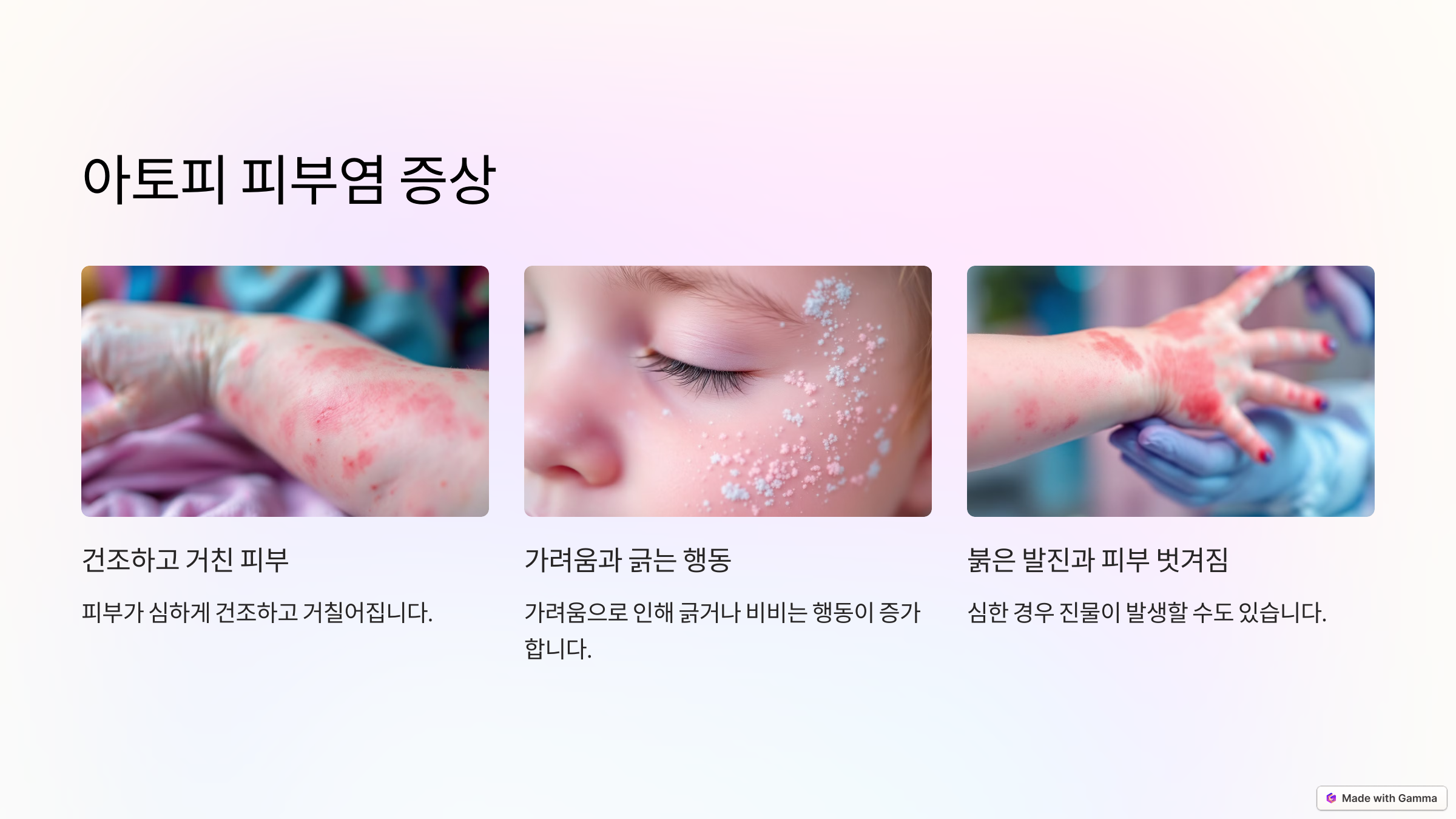 아토피 피부염 증상
