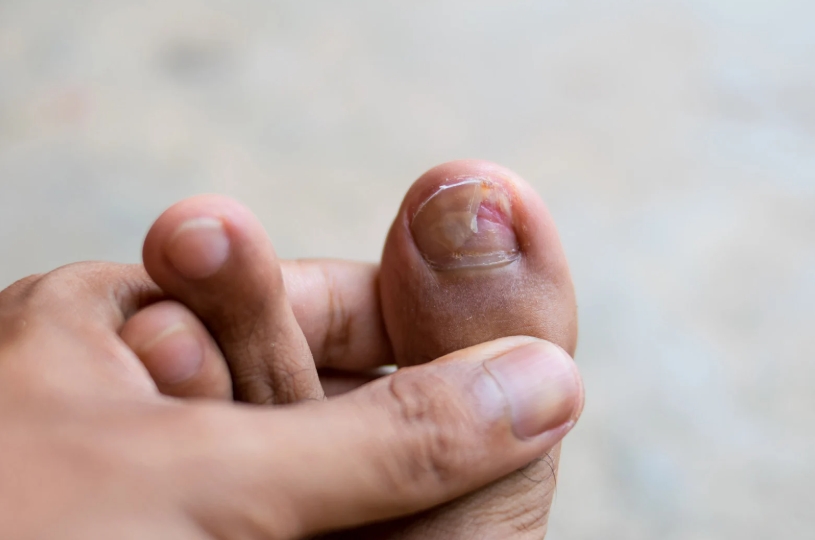 발톱무좀 유행 원인