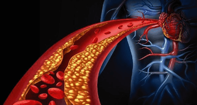 죽상동맥경화증사진