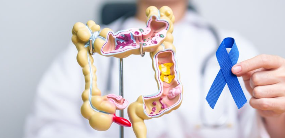 대장암 검사 방법, 초기 증상, 치료법