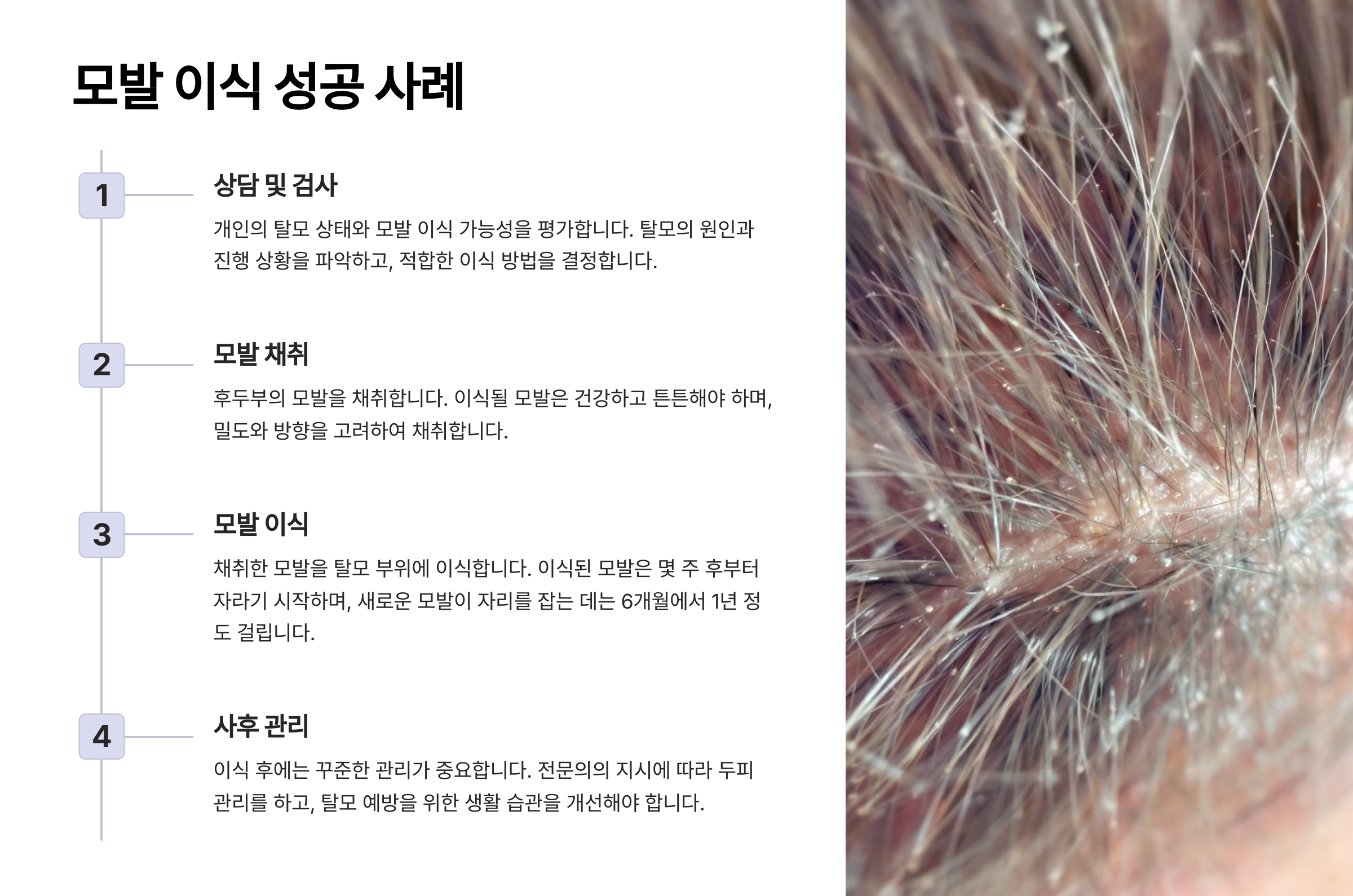 모발 이식 성공 사례